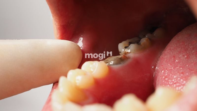 Nằm Mơ Thấy Gãy Răng Có Ý Nghĩa Gì? Lời Giải Mã Chi Tiết 1 Mơ thấy gãy răng là điềm báo gì?