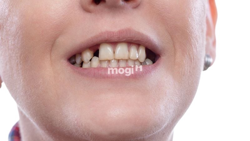 Nằm Mơ Thấy Gãy Răng Có Ý Nghĩa Gì? Lời Giải Mã Chi Tiết 4 Mơ thấy gãy răng nhưng không chảy máu