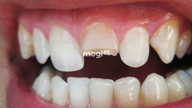 Nằm Mơ Thấy Gãy Răng Có Ý Nghĩa Gì? Lời Giải Mã Chi Tiết 5 mo thay gay rang 6