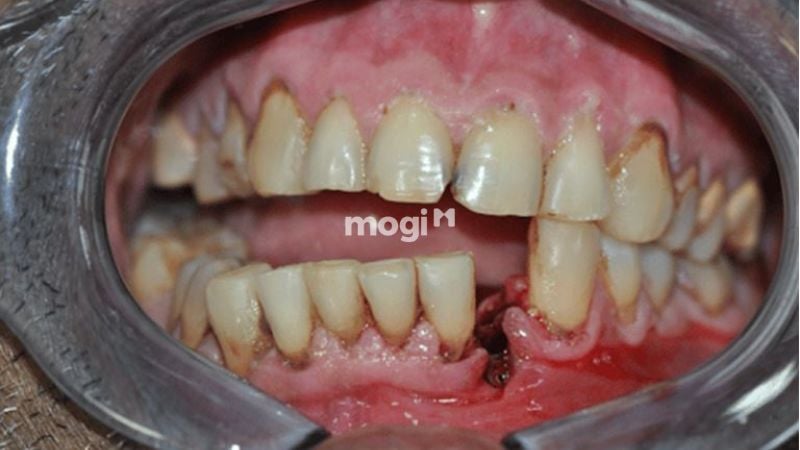 Nằm Mơ Thấy Gãy Răng Có Ý Nghĩa Gì? Lời Giải Mã Chi Tiết 6 Mơ thấy răng hàm dưới bị gãy