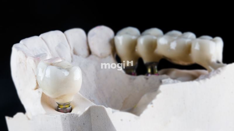 Nằm Mơ Thấy Gãy Răng Có Ý Nghĩa Gì? Lời Giải Mã Chi Tiết 7 Mơ thấy răng giả bị gãy