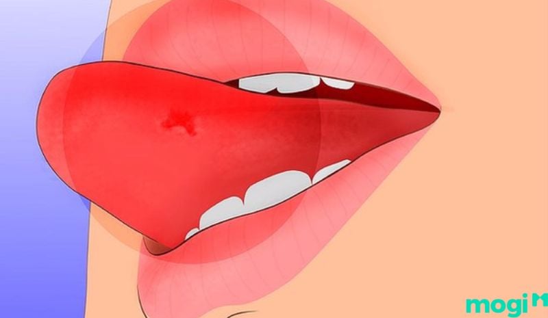 Cắn vào lưỡi là điềm gì - Cắn vào lưỡi dẫn đến bị sưng/ viêm