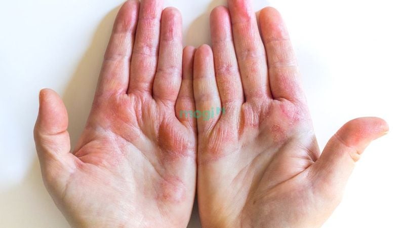 Ngứa lòng bàn tay phải là điềm gì? Cách xử lý hiệu quả 2 Nguyên nhân lòng bàn tay phải bị ngứa
