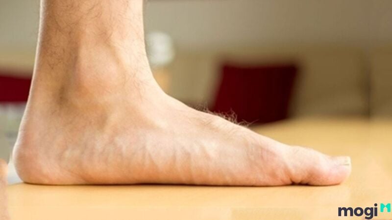 Tướng bàn chân sướng lông dày rậm