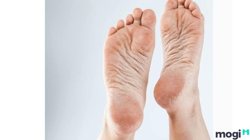 Tướng bàn chân khô cứng