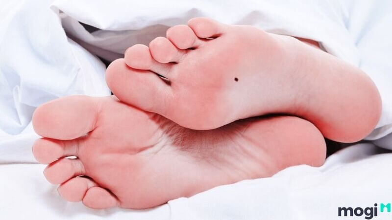 Tướng bàn chân có nốt ruồi