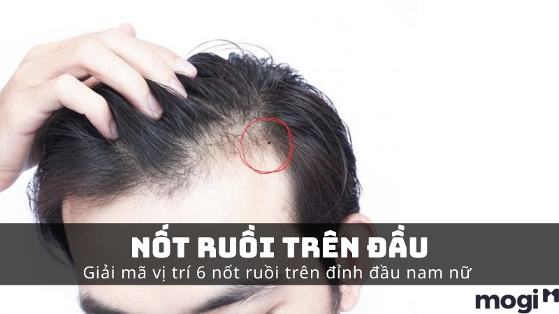 Nốt Ruồi Trên Đầu Có Ý Nghĩa Gì? Giải Mã 5+ Vị Trí Theo Nhân Tướng Học